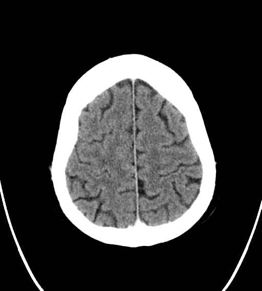 File:Chondrosarcoma of skull base- grade II (Radiopaedia 40948-43653 Axial Contrast 25).png