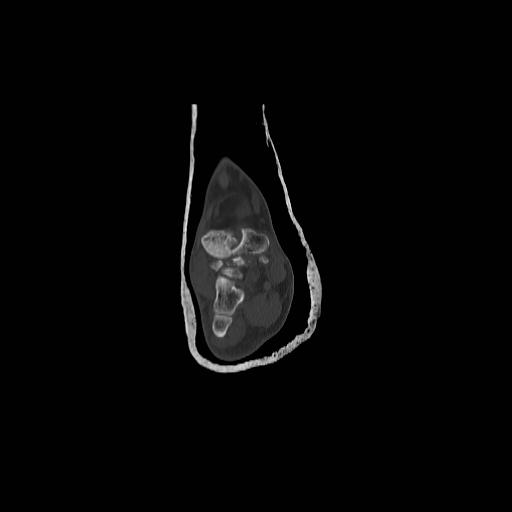 File:Chopart fracture (Radiopaedia 12386-12650 Coronal bone window 8).jpg
