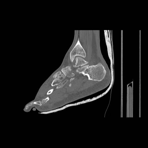 File:Chopart fracture (Radiopaedia 12386-12650 Sagittal bone window 21).jpg
