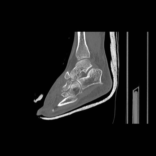 File:Chopart fracture (Radiopaedia 12386-12650 Sagittal bone window 9).jpg