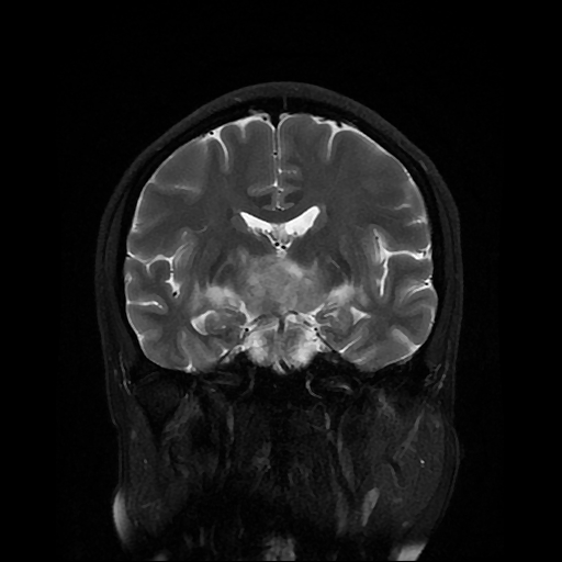 File:Chordoid glioma of third ventricle (Radiopaedia 91612-109340 Coronal T2 15).jpg