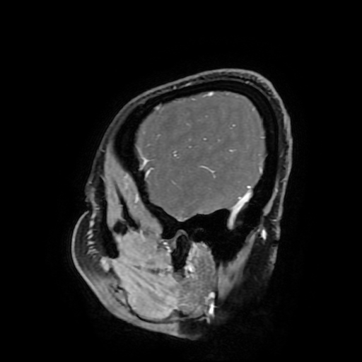 Chordoid glioma of third ventricle (Radiopaedia 91612-109340 F 175).jpg