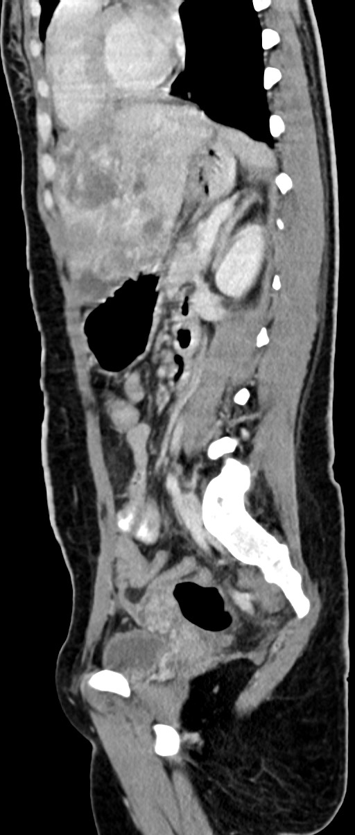 Choriocarcinoma liver metastases (Radiopaedia 74768-85766 C 83).jpg