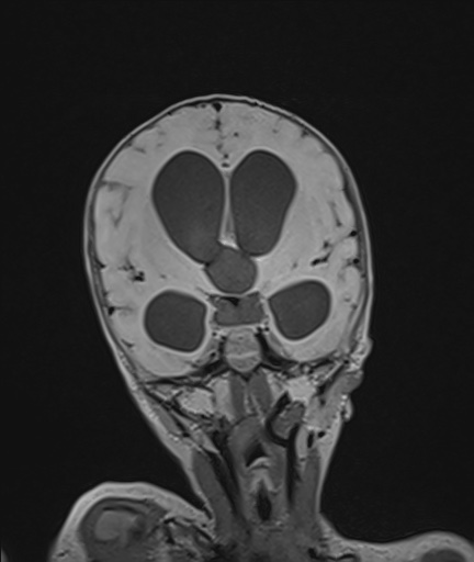 Choroid plexus papilloma (Radiopaedia 84612-100019 Coronal FLAIR 54).jpg