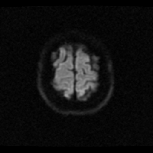 File:Choroid plexus xanthogranuloma (Radiopaedia 17650-17386 DWI 2).jpg