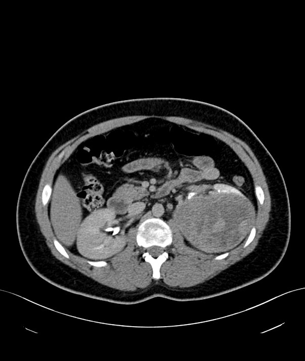 Chromophobe renal cell carcinoma (Radiopaedia 84255-99542 H 15).jpg