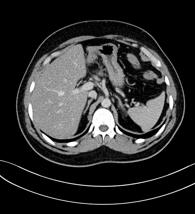 Chromophobe renal cell carcinoma (Radiopaedia 84286-99573 G 16).jpg