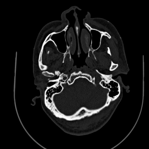 Chronic invasive fungal sinusitis (Radiopaedia 91563-109286 Axial sinus 15).jpg