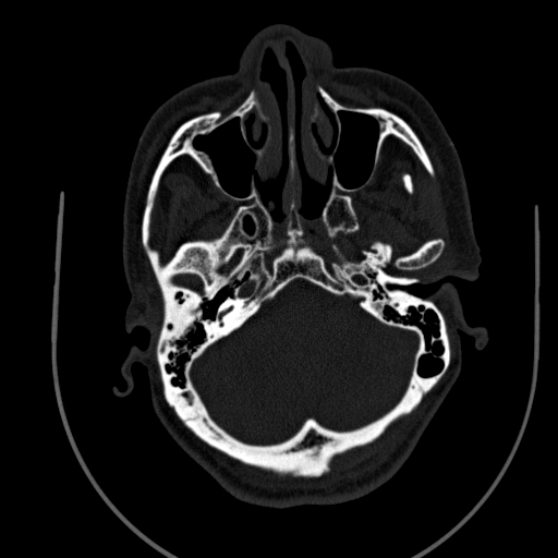 File:Chronic invasive fungal sinusitis (Radiopaedia 91563-109286 Axial sinus 30).jpg