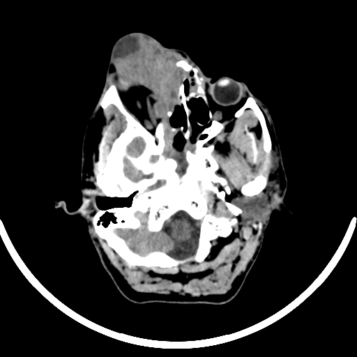 File:Chronic invasive fungal sinusitis with intraorbital and intracranial extension (Radiopaedia 56387-63046 Axial non-contrast 106).jpg