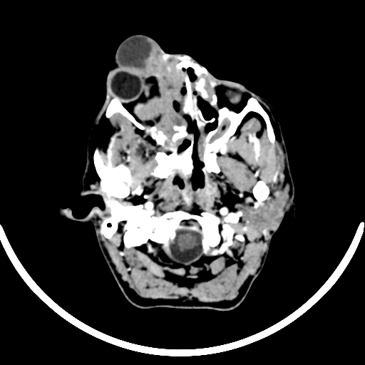 Chronic invasive fungal sinusitis with intraorbital and intracranial extension (Radiopaedia 56387-63046 B 66).jpg