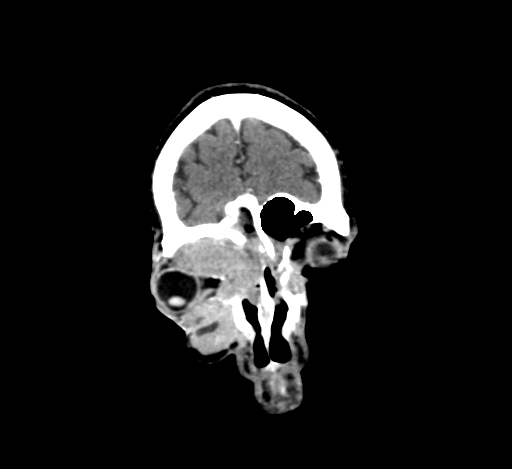 Chronic invasive fungal sinusitis with intraorbital and intracranial extension (Radiopaedia 56387-63046 C 59).jpg