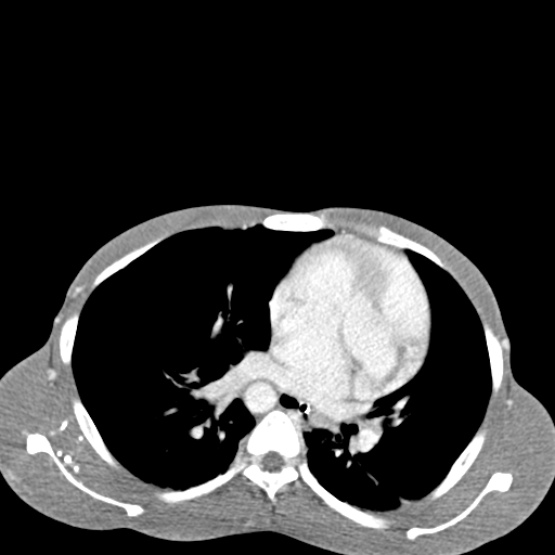 Chronic large bowel pseudo-obstruction (Radiopaedia 43181-46492 A 14).jpg
