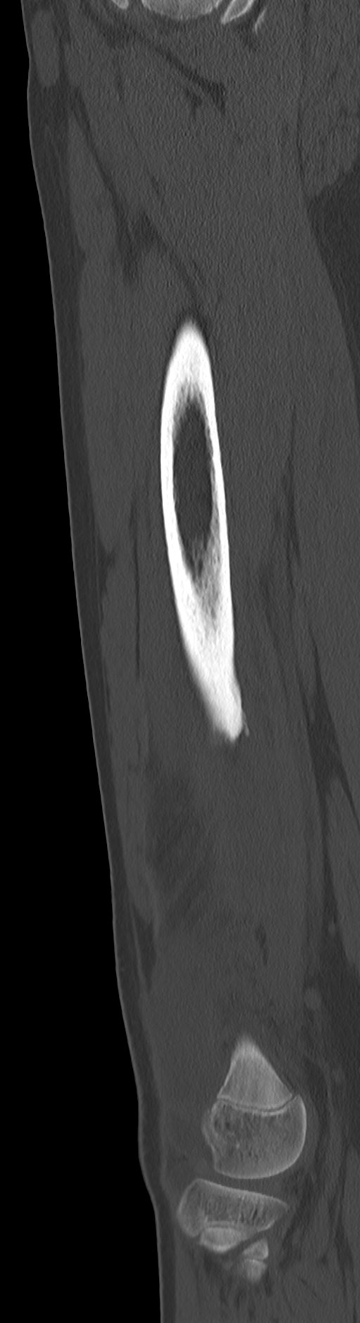 Chronic ostemyelitis of the femur with long sinus tract (Radiopaedia 74947-85982 Sagittal bone window 42).jpg
