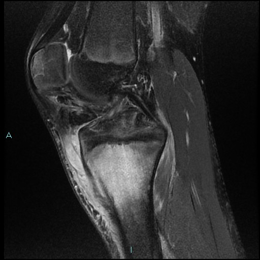 File:Chronic osteomyelitis (with Brodie abscess) (Radiopaedia 76405-88112 Sagittal PD fat sat 11).jpg