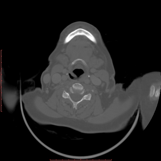 Chronic osteomyelitis - maxilla (Radiopaedia 23783-23927 Axial bone window 6).jpg