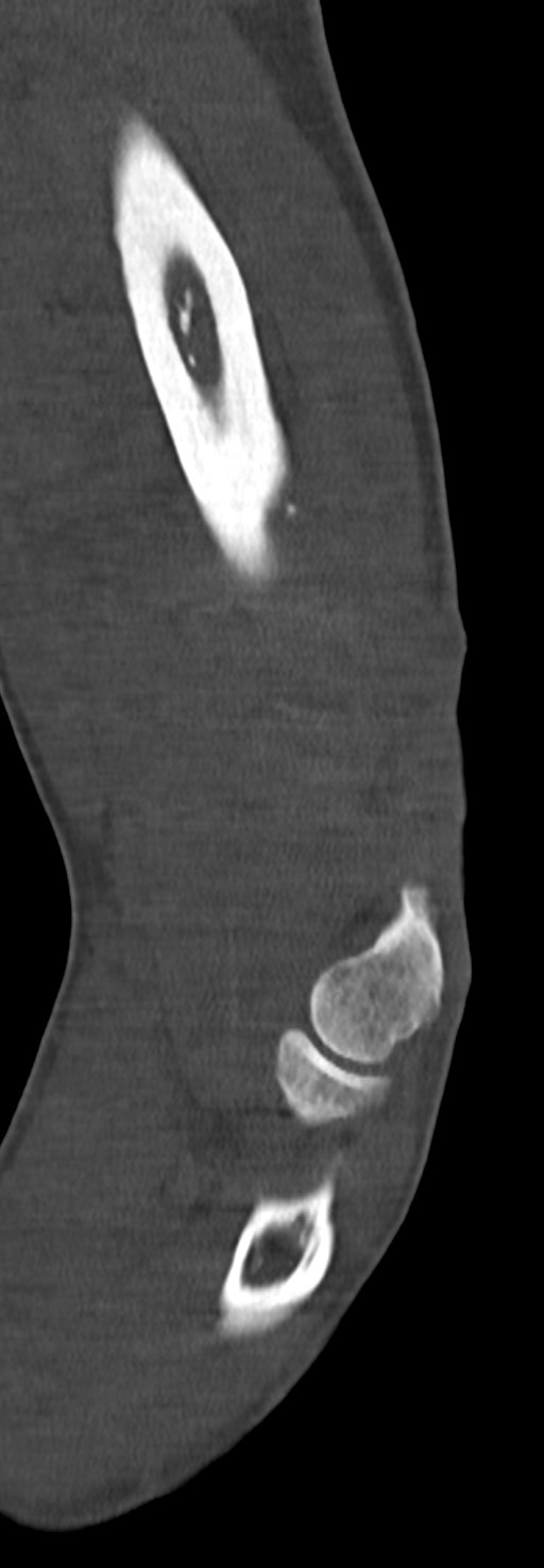 Chronic osteomyelitis of the distal humerus (Radiopaedia 78351-90971 Sagittal bone window 45).jpg