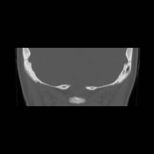 File:Chronic otomastoiditis (Radiopaedia 27138-27309 Coronal bone window 28).jpg