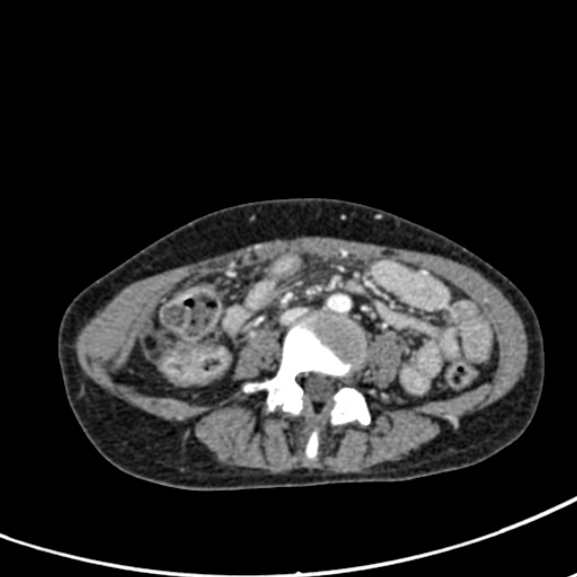 File:Chronic pancreatitis (Radiopaedia 55405-61846 A 62).jpg