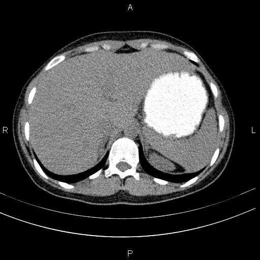 File:Chronic pancreatitis (Radiopaedia 64576-73450 Axial non-contrast 22).jpg