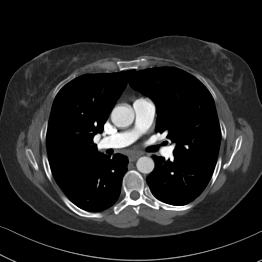 Chronic pulmonary embolus (Radiopaedia 39129-41341 Axial C+ CTPA 50).png