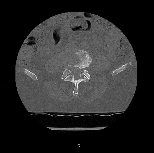 File:Chronic spinal hematoma with cauda equina syndrome (Radiopaedia 75745-88197 Axial bone window 42).png