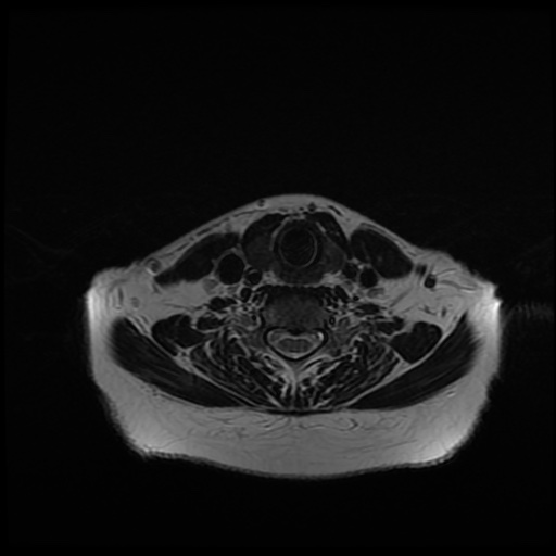 File:Chronic submandibular sialadenitis (Radiopaedia 61852-69885 Axial T2 24).jpg