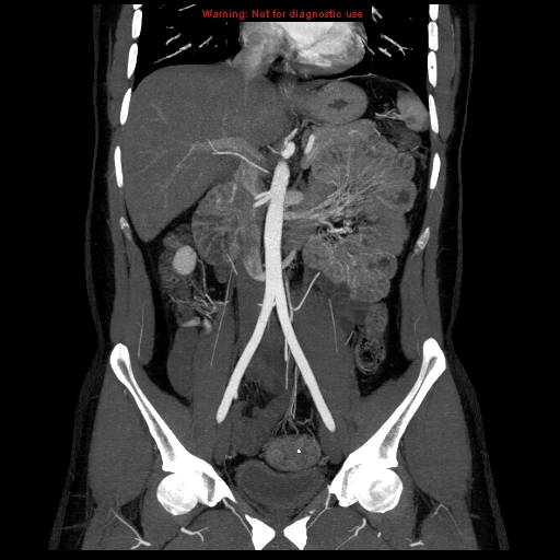 File:Circumaortic left renal vein (Radiopaedia 9069-9792 B 15).jpg