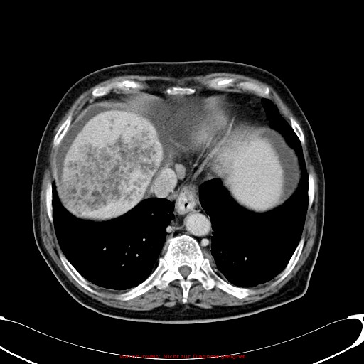 File:Cirrhosis and hepatocellular carcinoma in the setting of hemochromatosis (Radiopaedia 75394-86595 B 17).jpg
