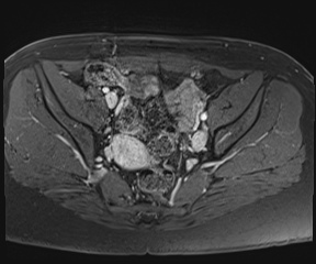 File:Class II Mullerian duct anomaly- unicornuate uterus with rudimentary horn and non-communicating cavity (Radiopaedia 39441-41755 Axial T1 fat sat 48).jpg
