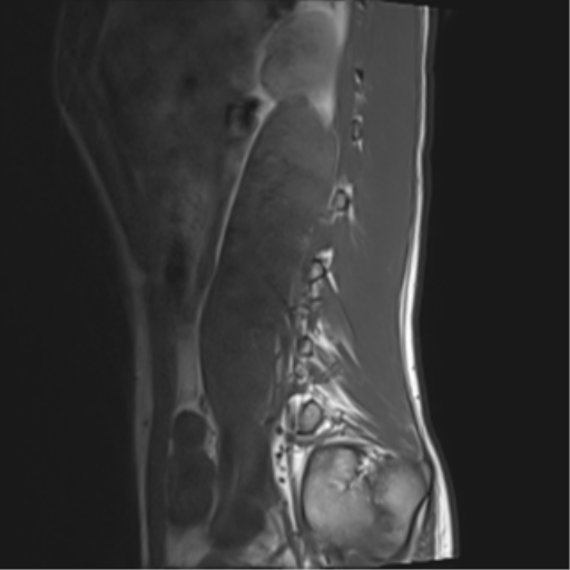 File:Clear cell meningoma - lumbar spine (Radiopaedia 60116-67690 Sagittal T1 2).png