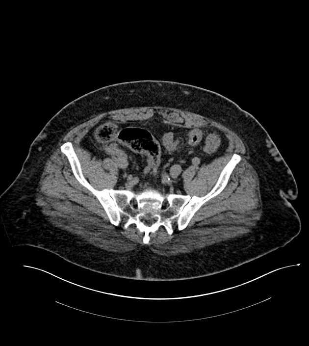 Closed-loop small bowel obstruction-internal hernia (Radiopaedia 78439-91096 Axial non-contrast 123).jpg