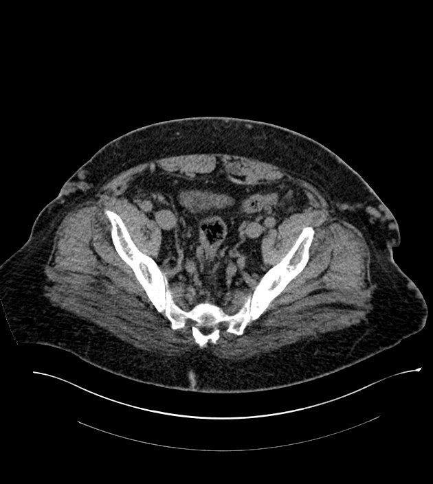 Closed-loop small bowel obstruction-internal hernia (Radiopaedia 78439-91096 Axial non-contrast 130).jpg