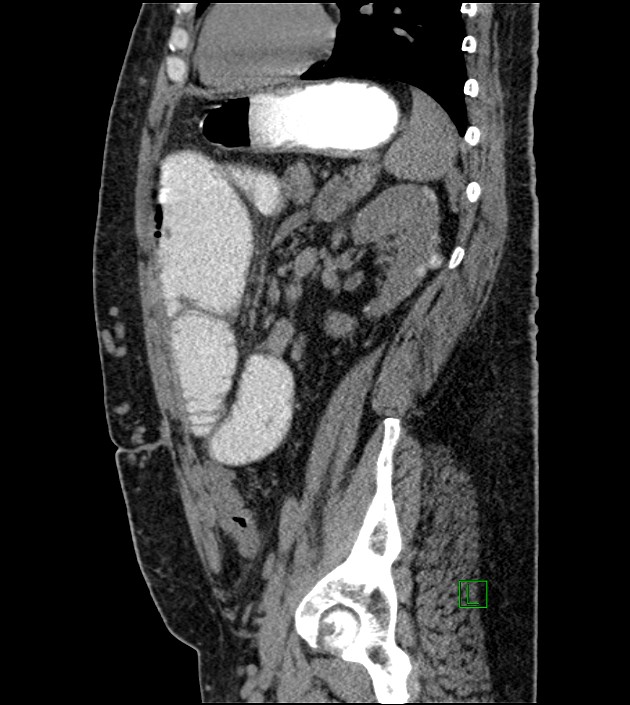 Closed-loop small bowel obstruction-internal hernia (Radiopaedia 78439-91096 C 54).jpg