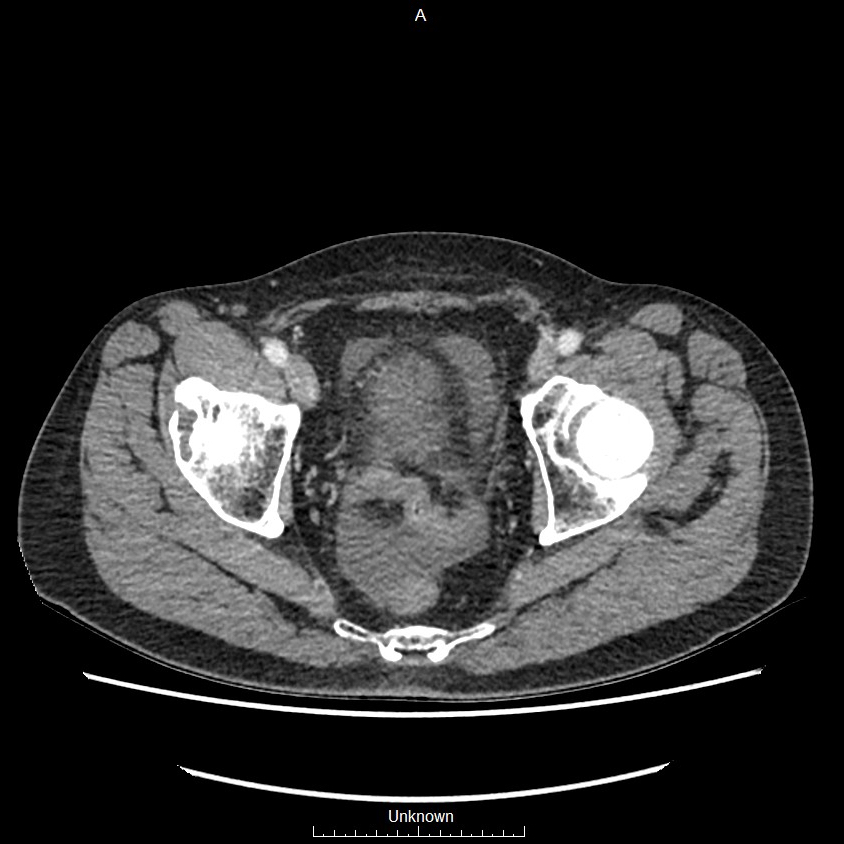 Closed loop bowel obstruction and ischemia (Radiopaedia 86959-103180 A 80).jpg
