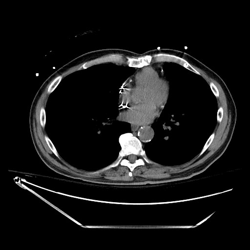 Closed loop obstruction due to adhesive band, resulting in small bowel ischemia and resection (Radiopaedia 83835-99023 Axial non-contrast 3).jpg