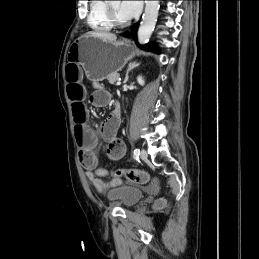 File:Closed loop obstruction due to adhesive band, resulting in small bowel ischemia and resection (Radiopaedia 83835-99023 F 112).jpg