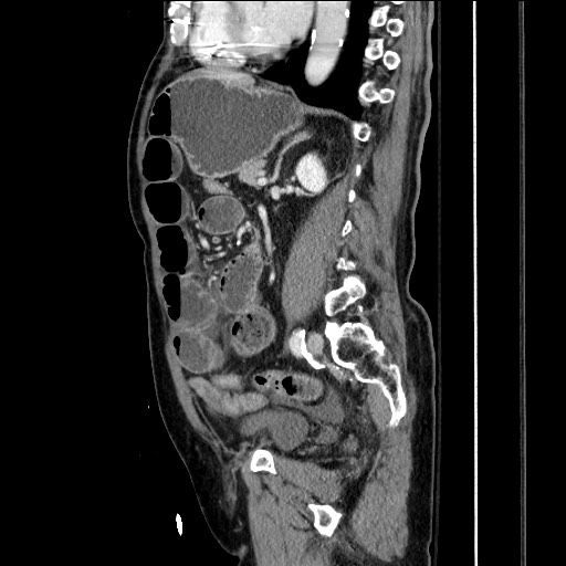 File:Closed loop obstruction due to adhesive band, resulting in small bowel ischemia and resection (Radiopaedia 83835-99023 F 114).jpg