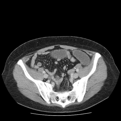File:Closed loop small bowel obstruction (Radiopaedia 65403-74451 Axial 30).jpg