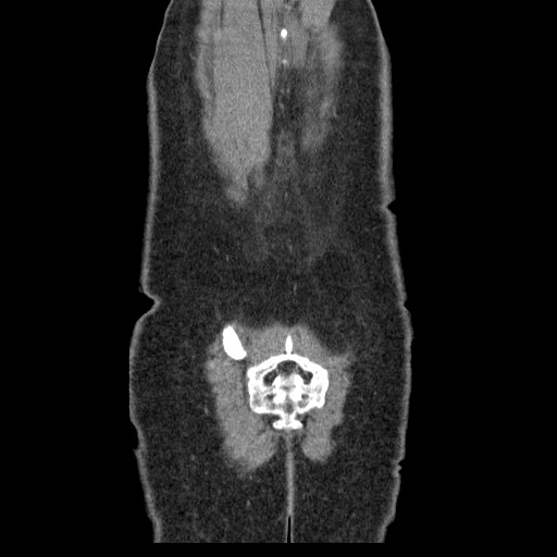 File:Closed loop small bowel obstruction (Radiopaedia 65403-74451 B 98).jpg