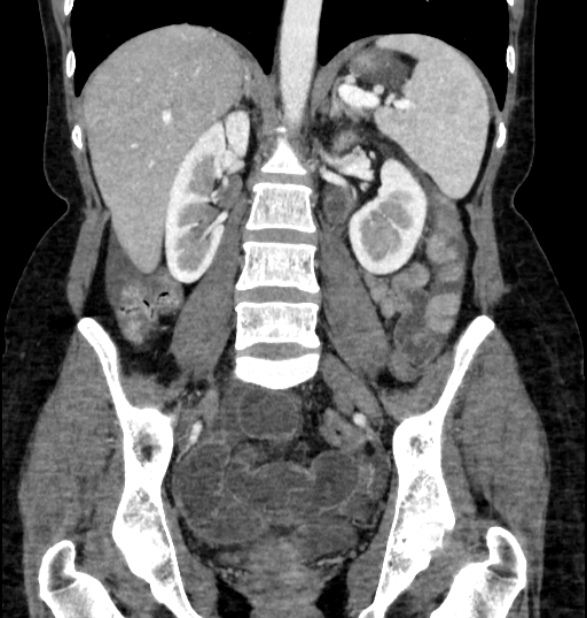 Closed loop small bowel obstruction (Radiopaedia 71211-81508 B 76).jpg