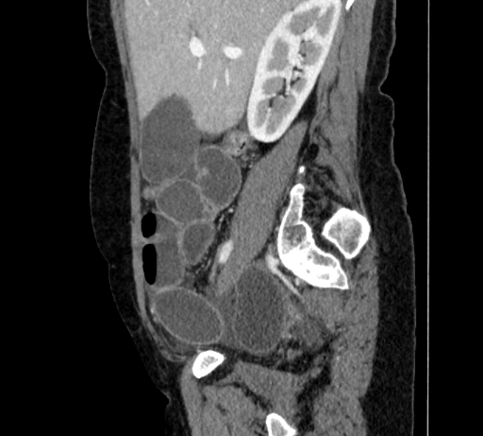 Closed loop small bowel obstruction (Radiopaedia 71211-81508 C 36).jpg