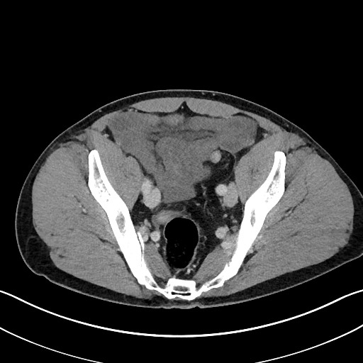 Closed loop small bowel obstruction - internal hernia (Radiopaedia 57806-64778 B 104).jpg