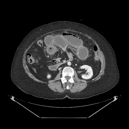 Closed loop small bowel obstruction - internal hernia (Radiopaedia 65402-74450 A 60).jpg