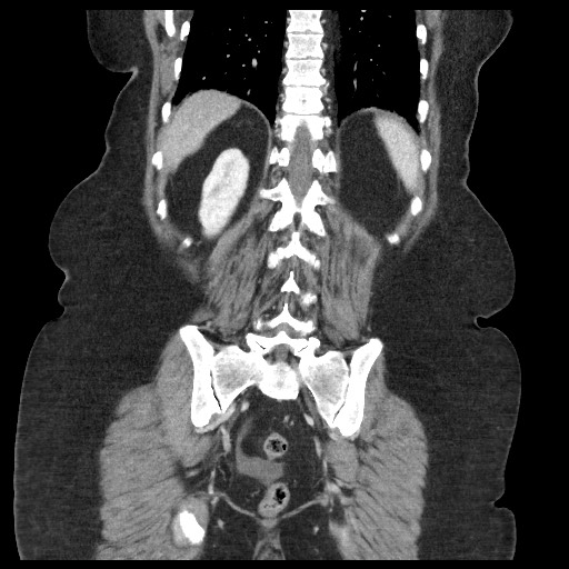 Closed loop small bowel obstruction - internal hernia (Radiopaedia 65402-74450 B 84).jpg