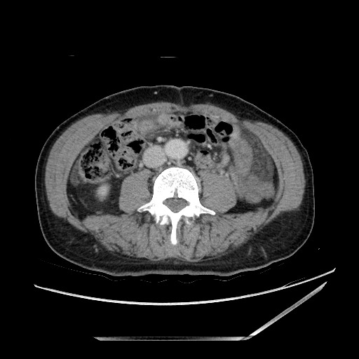 Closed loop small bowel obstruction - omental adhesion causing "internal hernia" (Radiopaedia 85129-100682 A 94).jpg