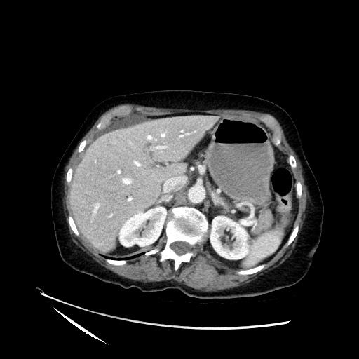 File:Closed loop small bowel obstruction due to adhesive band, with intramural hemorrhage and ischemia (Radiopaedia 83831-99017 Axial 83).jpg