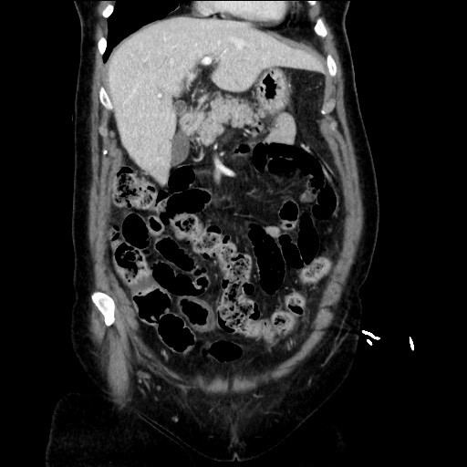 File:Closed loop small bowel obstruction due to adhesive bands - early and late images (Radiopaedia 83830-99014 B 41).jpg