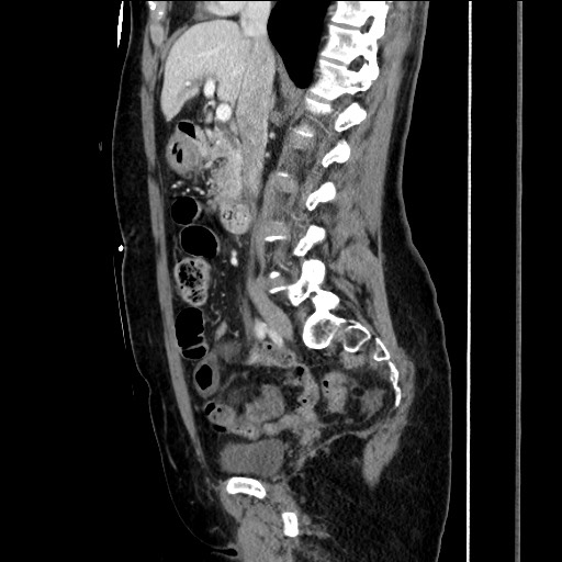 Closed loop small bowel obstruction due to adhesive bands - early and late images (Radiopaedia 83830-99014 C 82).jpg