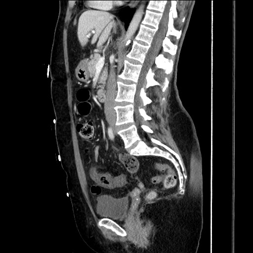 Closed loop small bowel obstruction due to adhesive bands - early and late images (Radiopaedia 83830-99014 C 90).jpg